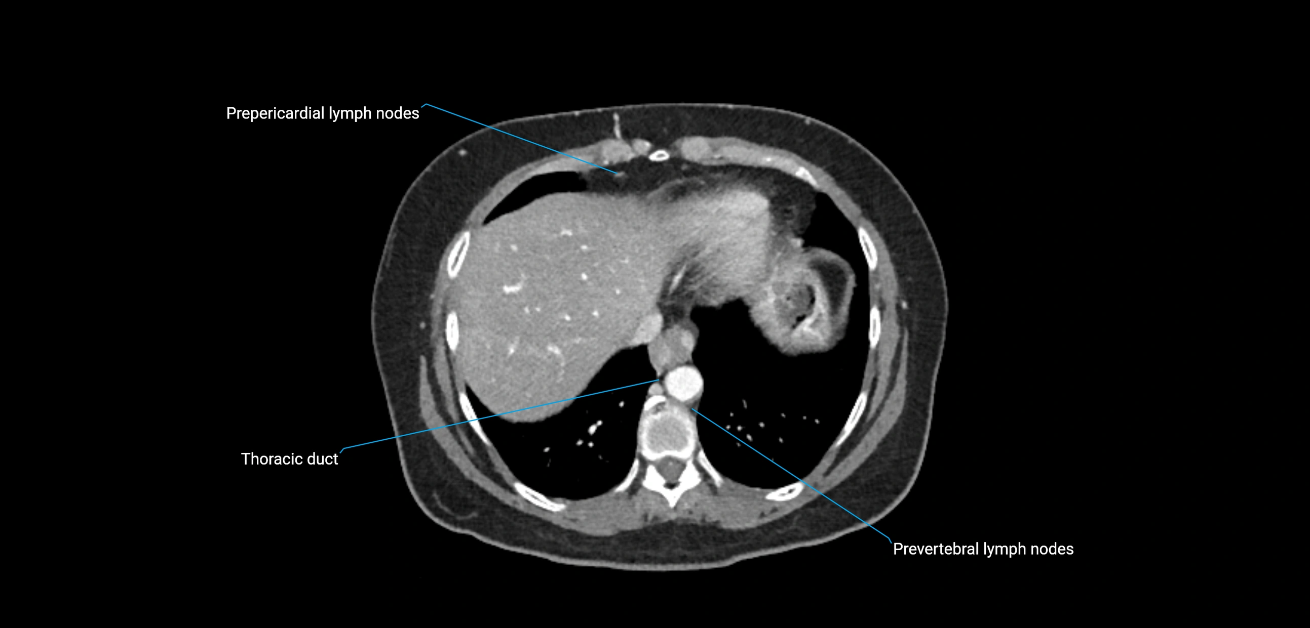 CT ct abdominal lymph nodes  axial cross sectional anatomy  enchanced radiology image -img-00002-00072.webp